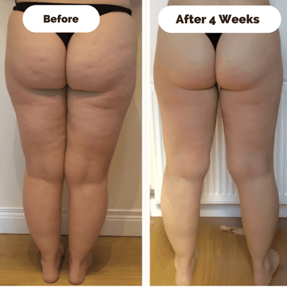 SKINLIFT – Dispositivo di massaggio rassodante contro la cellulite