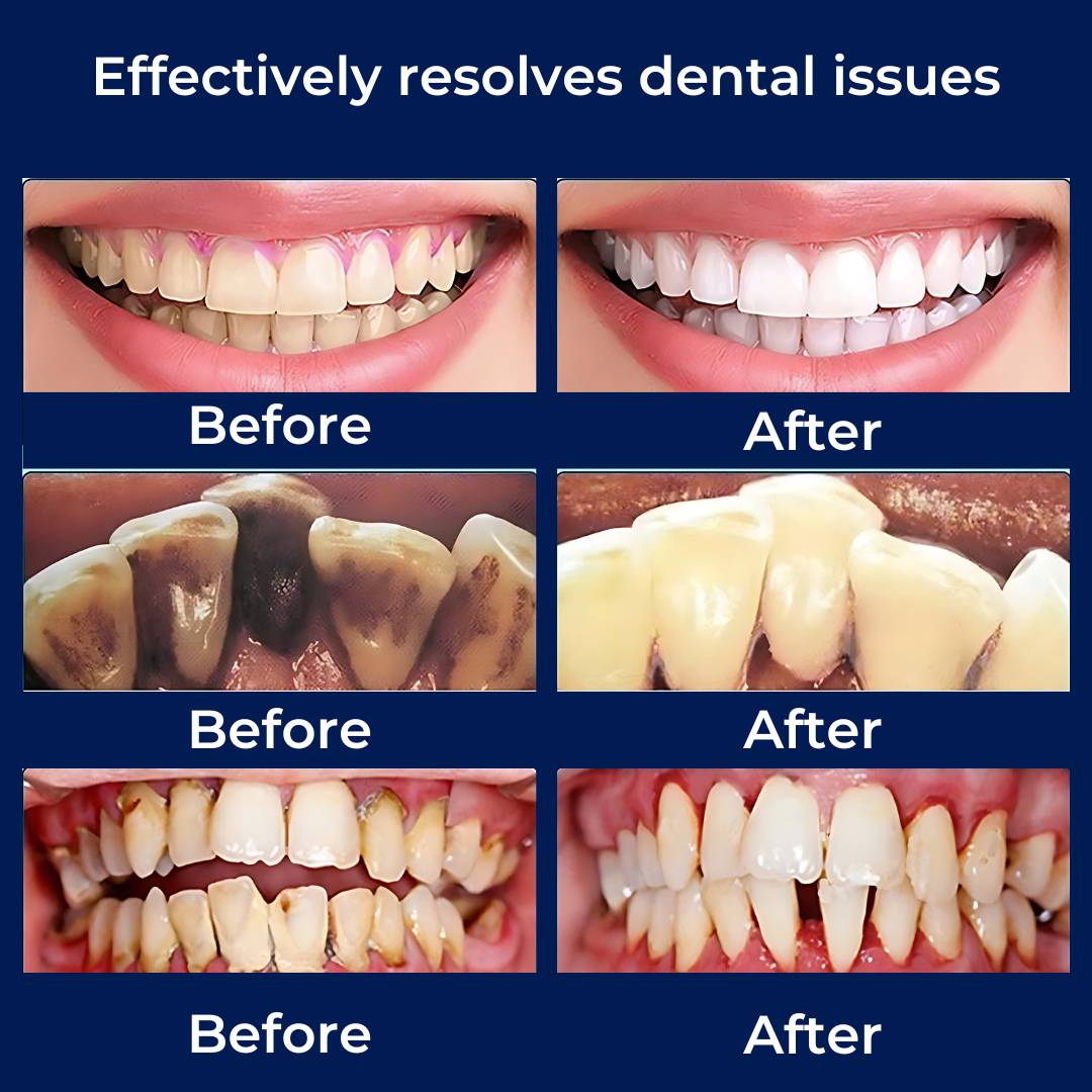 Plaquefree Plaque Remover per denti | Denti ad ultrasuoni Cleaner - Tartar Remover da casa - pulizia dei denti profondi e polacco
