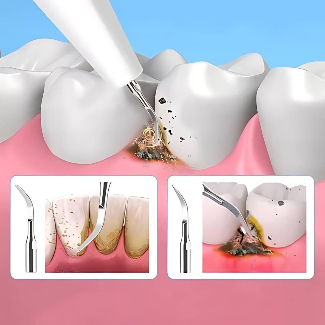 Plaquefree Plaque Remover per denti | Denti ad ultrasuoni Cleaner - Tartar Remover da casa - pulizia dei denti profondi e polacco