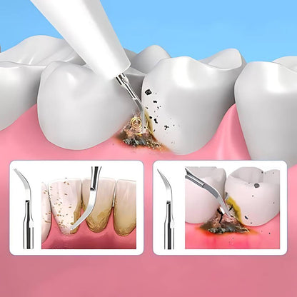 Plaquefree Plaque Remover per denti | Denti ad ultrasuoni Cleaner - Tartar Remover da casa - pulizia dei denti profondi e polacco
