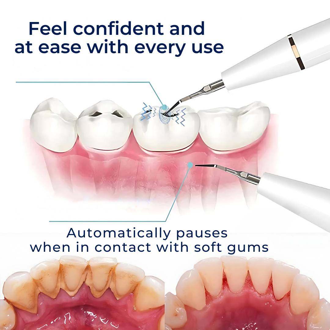 Plaquefree Plaque Remover per denti | Denti ad ultrasuoni Cleaner - Tartar Remover da casa - pulizia dei denti profondi e polacco