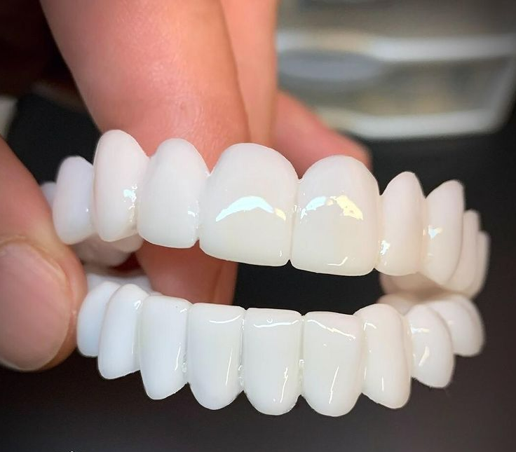 Faccette dentali estetiche professionali per un sorriso sicuro e splendido